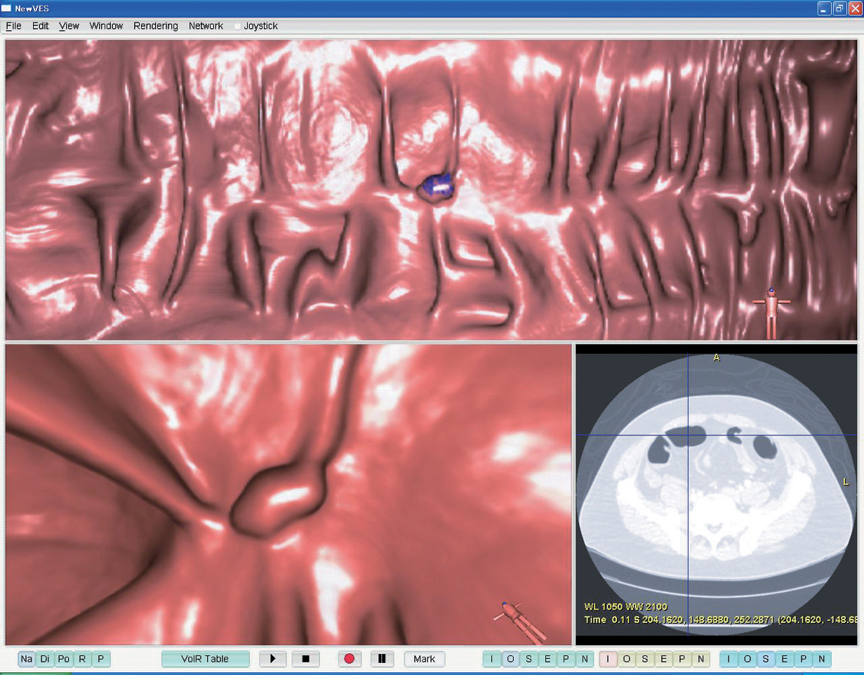 Figure : CAD system for colonic polyp detection